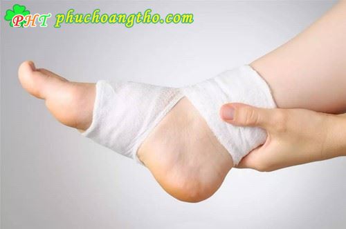 Chữa bong gân chân nhanh khỏi - Bài thuốc 3