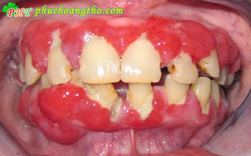 Thuốc trị sưng nướu răng có mủ - Bài thuốc 7