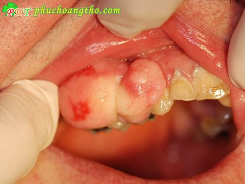 Bài thuốc đặc trị viêm nha chu viêm lợi - Bài thuốc 6 VNC
