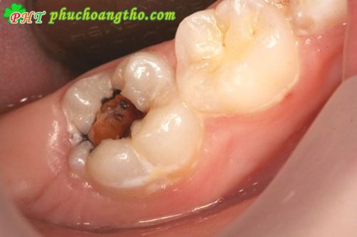 Chữa sâu răng khỏi hoàn toàn - Bài thuốc 3