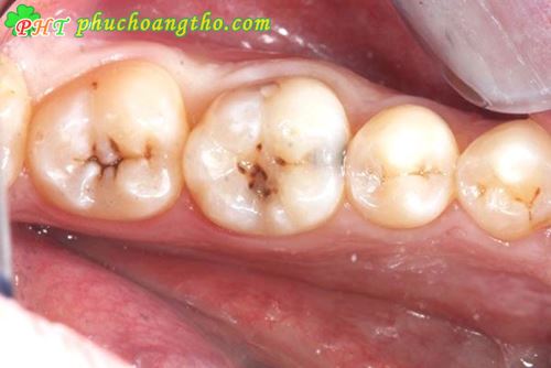 Trị đau nhức răng khỏi nhanh nhất - Bài thuốc 2