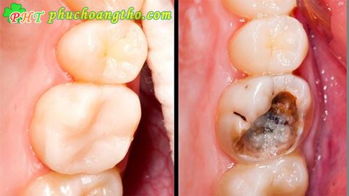 Cách trị đau răng cấp tốc - Bài thuốc 1