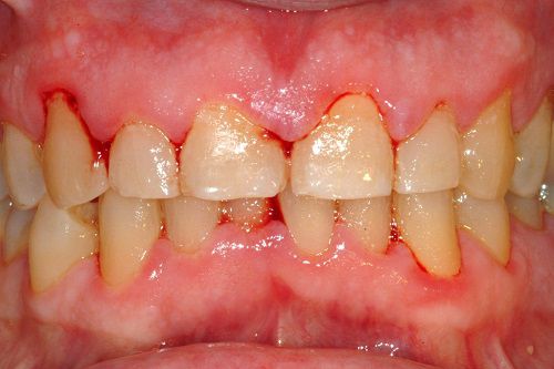 Nguyên nhân triệu chứng viêm nướu - Bài thuốc 8