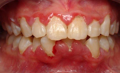 Thuốc điều trị viêm lợi đau chân răng - Bài thuốc 9