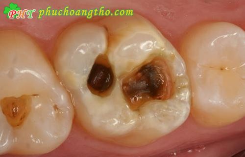 Sâu răng chảy máu chân răng - Bài thuốc 5