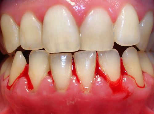 bệnh viêm nướu răng có mủ chảy máu hôi miệng